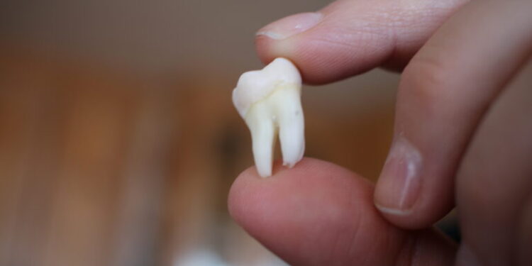 C’est quoi une dent de sagesse