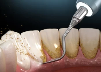 L’importance du détartrage dentaire