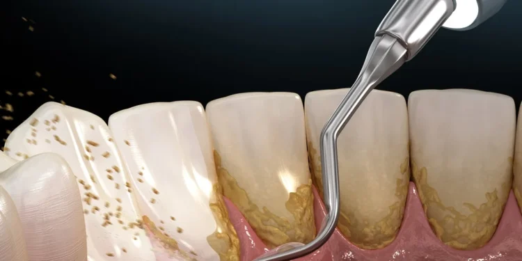 L’importance du détartrage dentaire