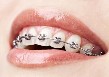 L’orthodontie, une solution aux anomalies dentaires