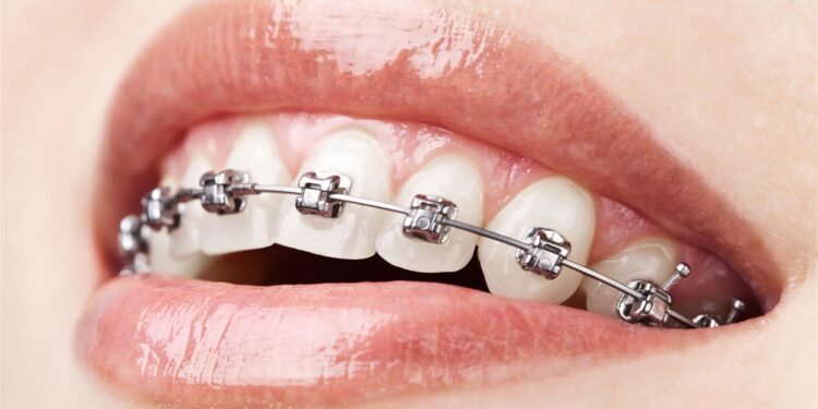 L’orthodontie, une solution aux anomalies dentaires