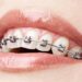L’orthodontie, une solution aux anomalies dentaires
