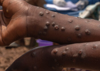 EPIDEMIE DE MPOX (VARIOLE DU SINGE) AU SENEGAL