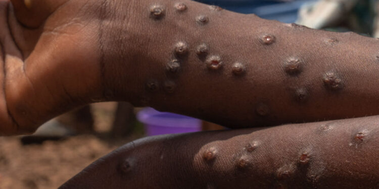 EPIDEMIE DE MPOX (VARIOLE DU SINGE) AU SENEGAL