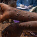 EPIDEMIE DE MPOX (VARIOLE DU SINGE) AU SENEGAL