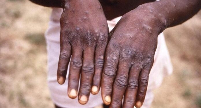 SITUATION EPIDEMIOLOGIQUE DU MPOX A MADAGASCAR : Un premier décès enregistré